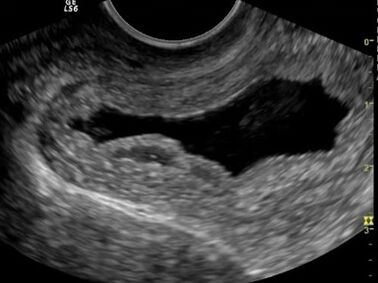 The ultrasound showed chronic cystitis